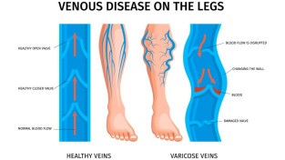 realistic varicose veins anatomy infographics.jpg