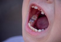 사는 동네 따라 충치 수도 달라진다... 홍콩 유치원생 치아 건강도 