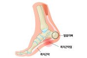 족천근막염과 발바닥 통증의 이해: 홍콩 카이로프랙틱 전문의가 전하는 가이드 [칼린 박사 건강칼럼]