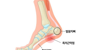 족천근막염과 발바닥 통증의 이해: 홍콩 카이로프랙틱 전문의가 전하는 가이드 [칼린 박사 건강칼럼]