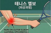 팔꿈치 통증? 골프 엘보와 테니스 엘보의 차이점 - [칼린 박사 건강칼럼]