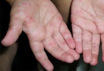 [홍콩뉴스] "중국 놀이터 주의" 광둥성 수족구병 대확산에 홍콩 의사들 비상 권고