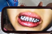 中서 유치원생 20여명 '납중독 파문'…머리 빠지고 치아 까매져