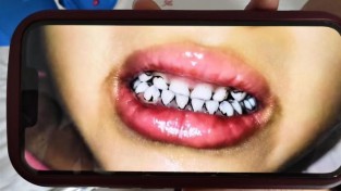 中서 유치원생 20여명 '납중독 파문'…머리 빠지고 치아 까매져