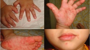 홍콩, 수족구병 한 달간 78건 발생…학교에 큰 타격